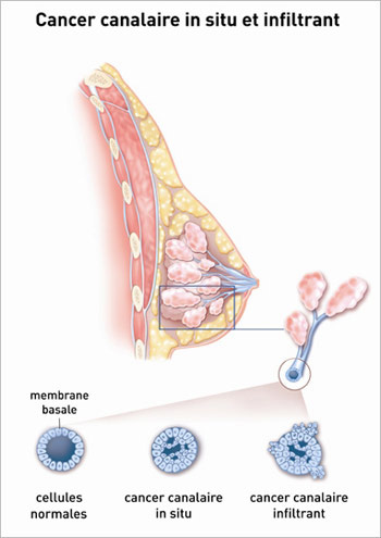Cancer canalaire in situ et infiltrant