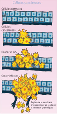 Types de cancer du sein : Les cellules cancéreuses