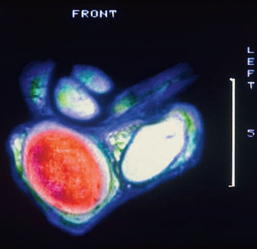 Depistage cancer testicule