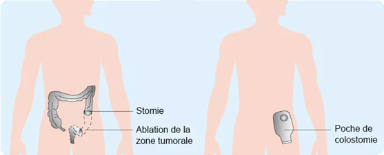 Cancer colorectal | Ligue contre le cancer