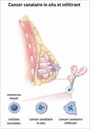 cancer du sein