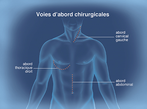 œsophage voies chirurgicales